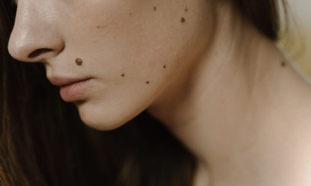 woman face with spots