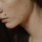 woman face with spots