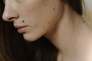 woman face with spots